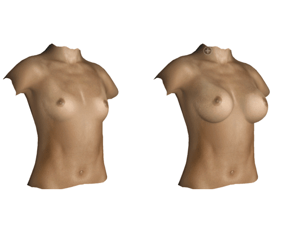La simulation 3D pour la chirurgie de la poitrine à Perpignan par le Dr Canizares