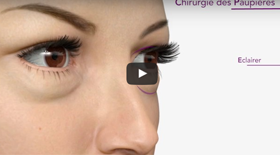 Blépharoplastie / chirurgie des paupières