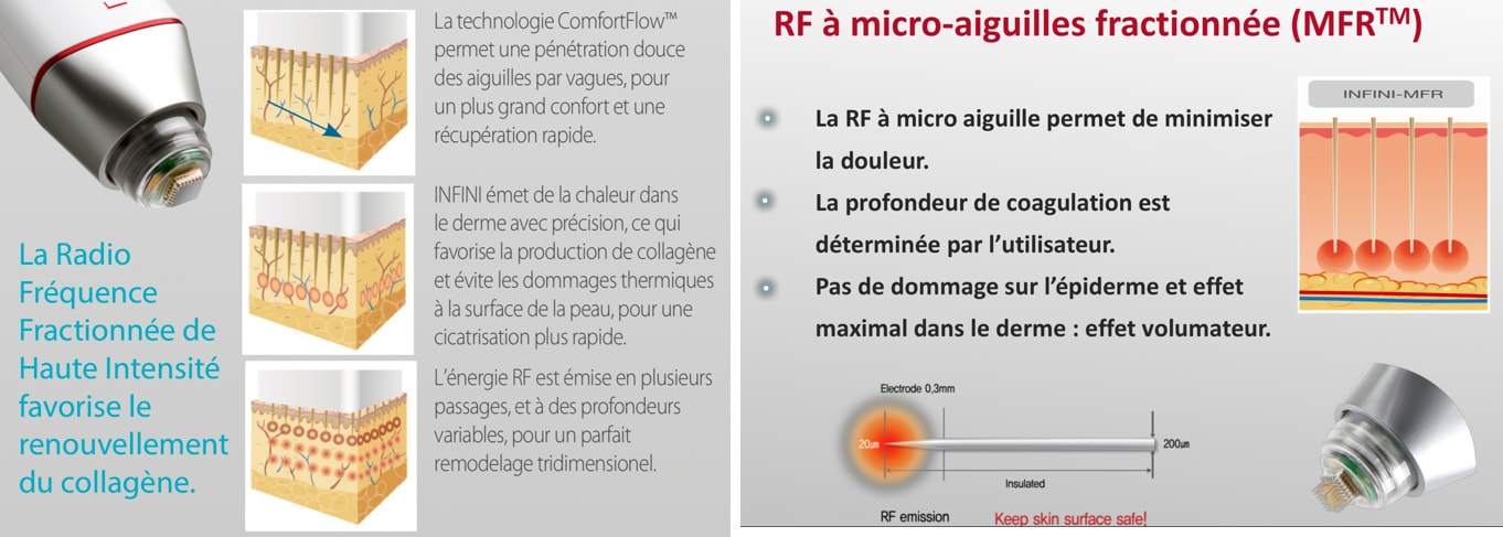 Traitement par radiofréquence à Montpellier