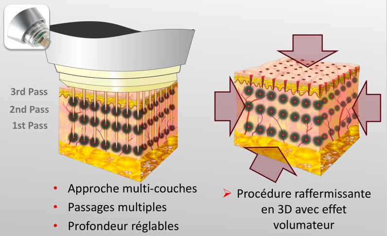 La radiofréquence à micro aiguilles haute intensité