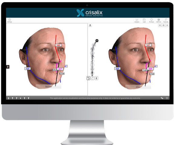 La simulation 3D pour la rhinoplastie à Perpignan par le Dr Canizares