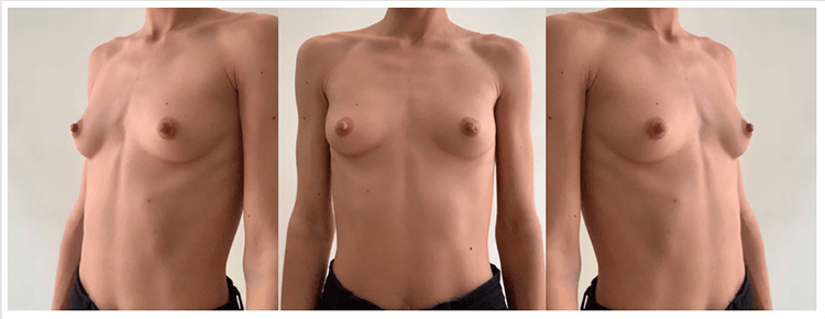 Tutoriel de téléconsultation 3D crisalix pour la chirurgie des seins à Perpignan